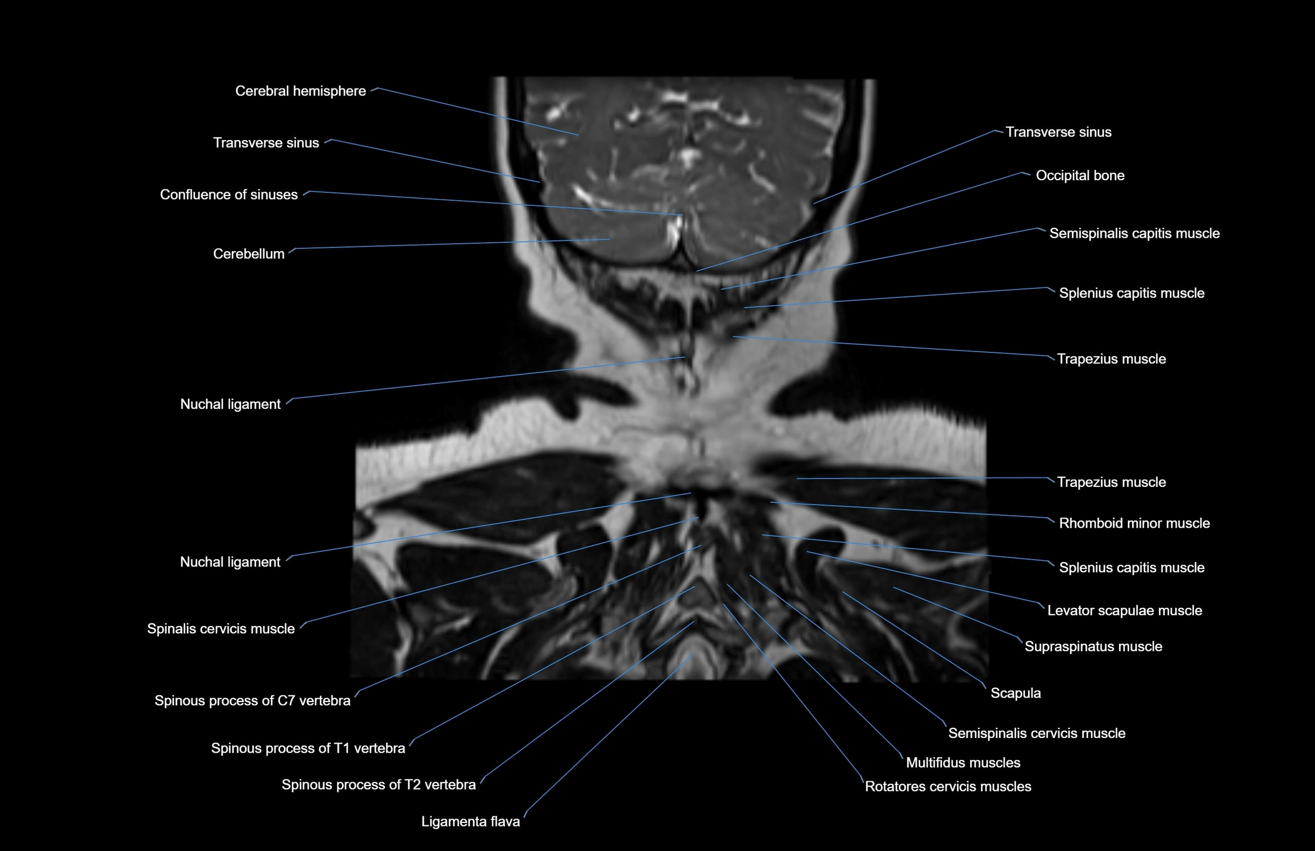 Neck coronal cross sectional MRI anatomy 3T MRI  image-img-00001-00005.webp
